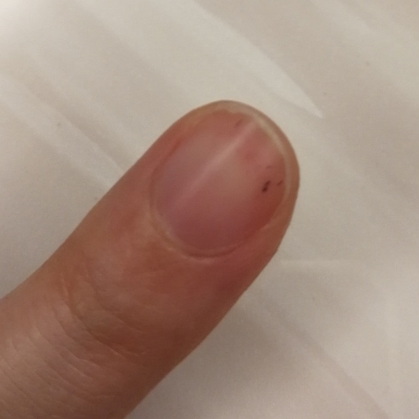 手指甲上有黑点是怎么回事_手指甲上黑色点_手指甲有黑点是什么病的征兆