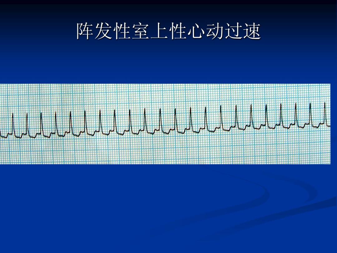 尸毒过木阵_2016上砂新闻上砂过老_阵发性室上性心动过扑