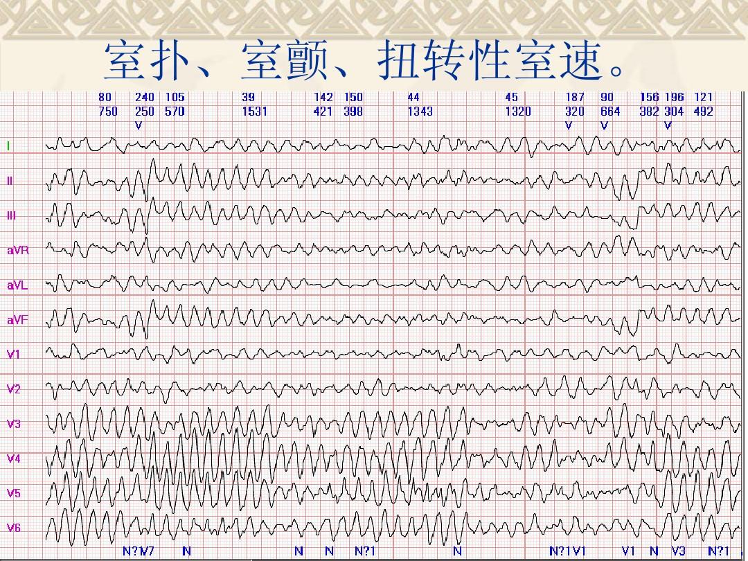 阵发性心房扑动的治疗_阵发性心房扑动吃什么药_阵发性室上性心动过扑