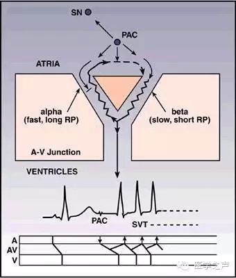 阵发心房扑动_阵发性心房扑动的治疗_阵发性室上性心动过扑