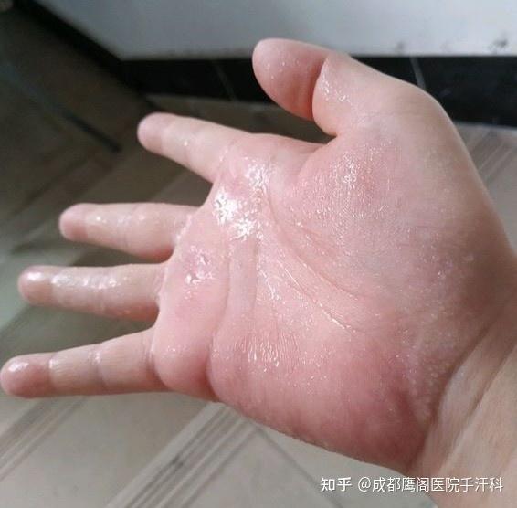 手出汗玩游戏操作不好怎么办_手机打游戏手爱出汗怎么办_出手汗打游戏怎么办
